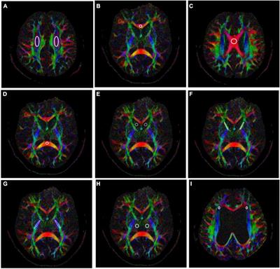 Preliminary Exploration of the Sequence of Nerve Fiber Bundles Involvement for Idiopathic Normal Pressure Hydrocephalus: A Correlation Analysis Using Diffusion Tensor Imaging